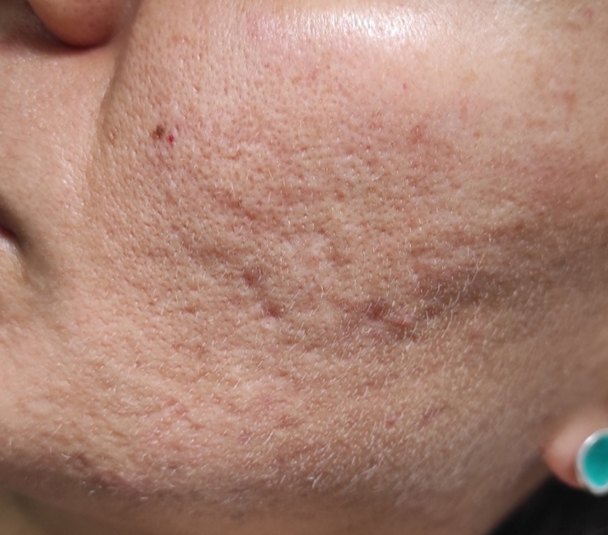 Melasma - Antes