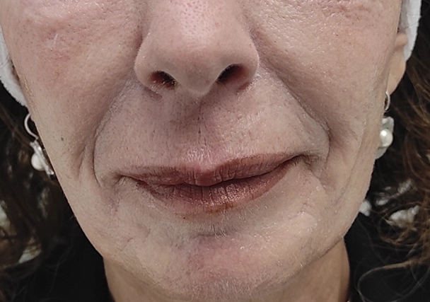 Melasma - Antes