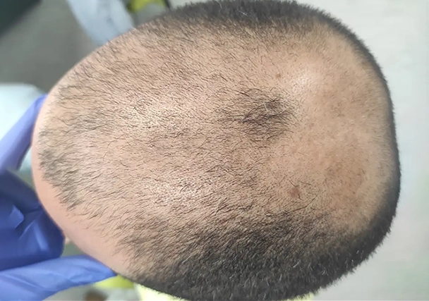 Melasma - Antes