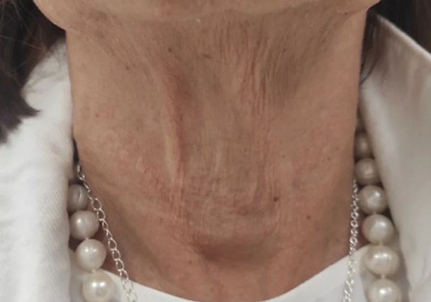 Melasma - Antes