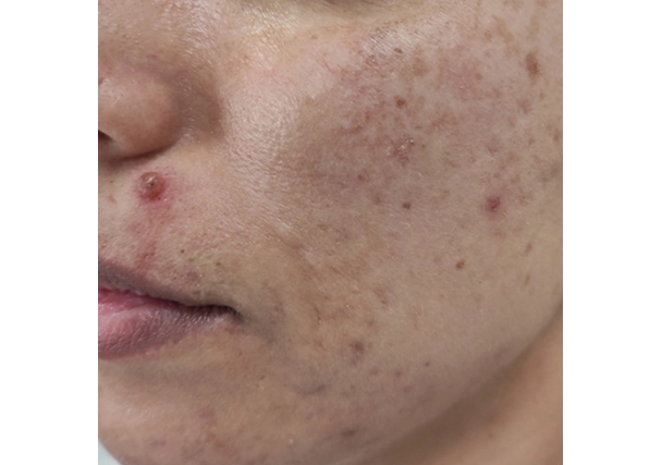 Melasma - Antes