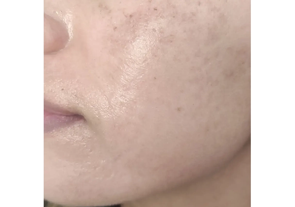 Melasma - Después