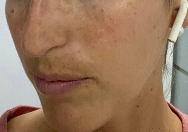 Melasma - Antes