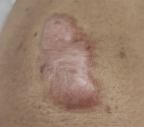 Melasma - Antes