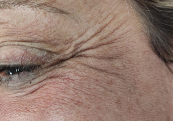 Melasma - Antes